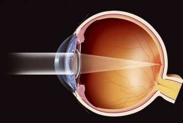 El glaucoma, una de las causas más comunes de ceguera…