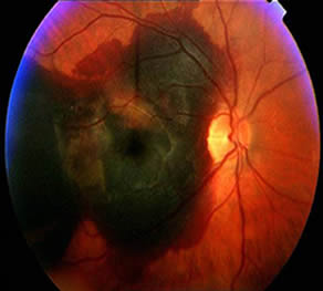 Degeneracion Macular asociada a la edad